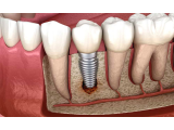 Taksitle implant Ankara